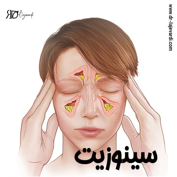 سینوزیت - دکتر محمد لاجوردی