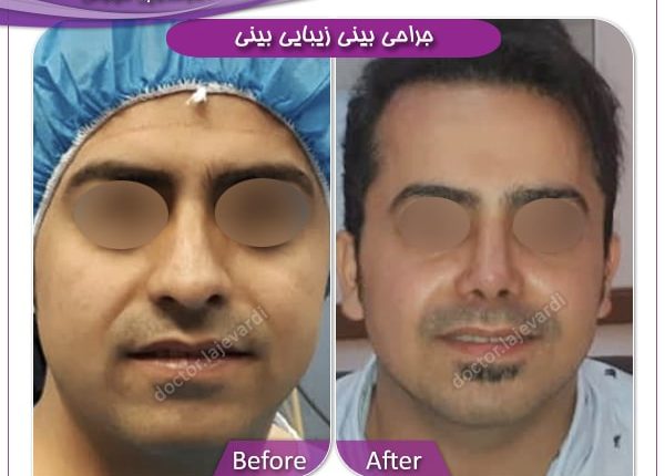 جراحی بینی