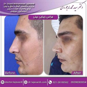 جراحی-بینی-53