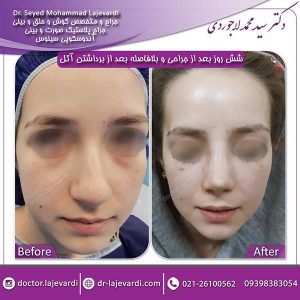 جراحی-بینی-60