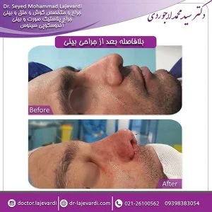 جراحی-بینی-61