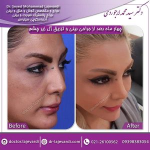 جراحی-بینی-و-تزریق-ژل-1