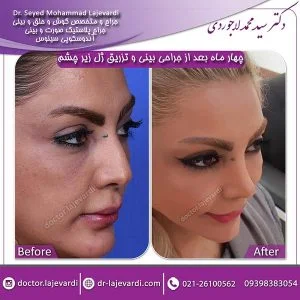 جراحی-بینی-و-تزریق-ژل-1