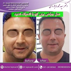 جراحی بینی کج