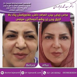 جراحی پلک
