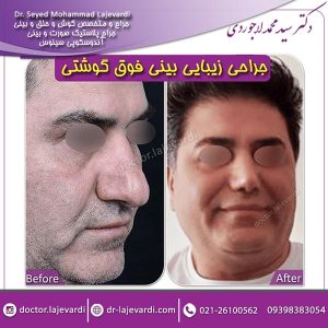 عمل بینی گوشتی 