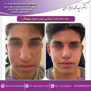 عمل بینی بدون بیهوشی - دکتر سید محمد لاجوردی