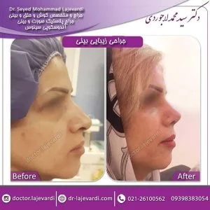کوچک کردن بینی بدون جراحی - دکتر لاجوردی