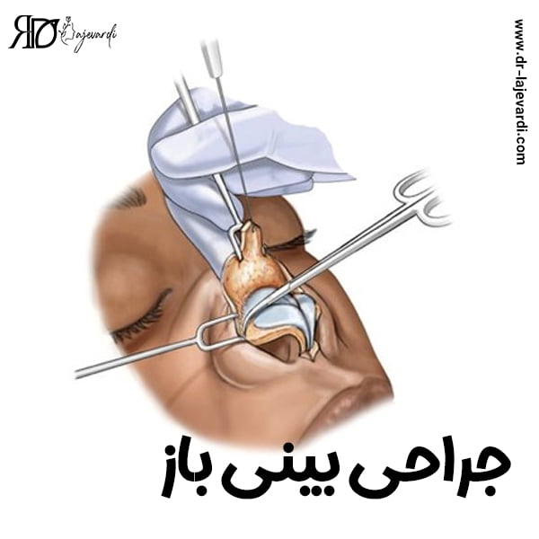 جراحی بینی باز - دکتر محمد لاجوردی