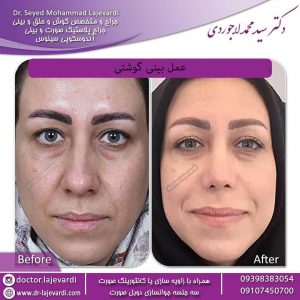 عمل بینی گوشتی