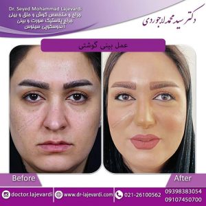 عمل بینی گوشتی