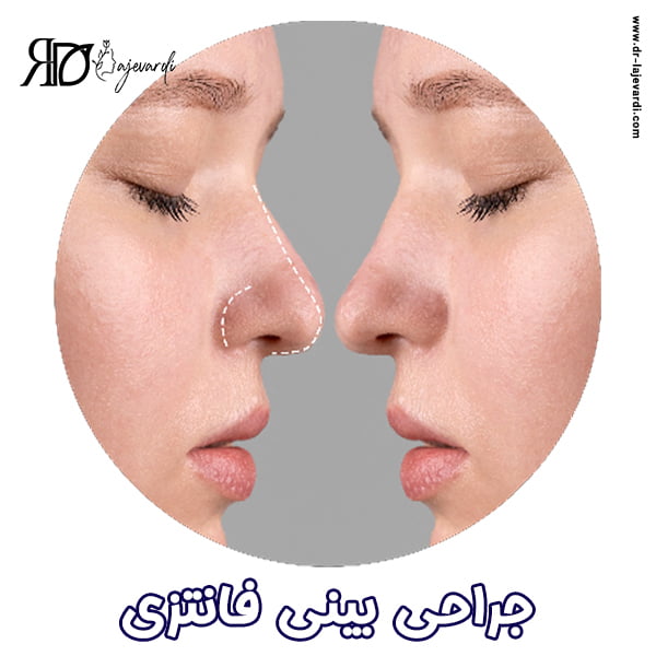 جراحی بینی فانتزی - دکتر محمد لاجوردی