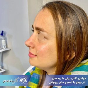 جراحی بینی با بیحسی - دکتر محمد لاجوردی