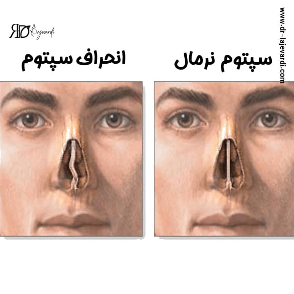 عمل انحراف بینی - دکتر محمد لاجوردی