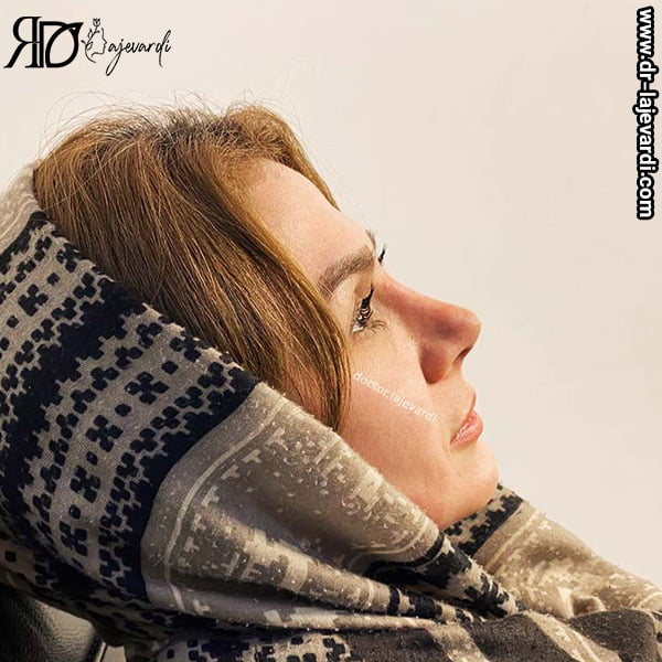 نمونه کار بهترین جراح بینی تهران - دکتر محمد لاجوردی