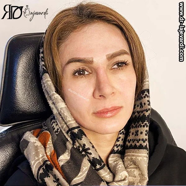 نمونه کار جراح بینی تهران - دکتر محمد لاجوردی