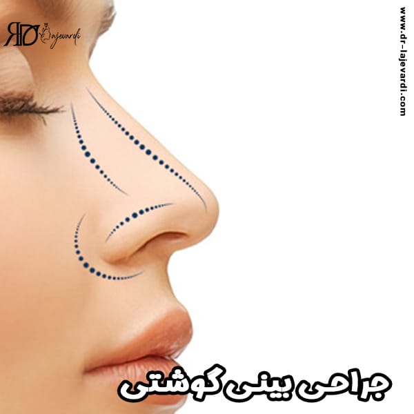 جراحی بینی گوشتی - دکتر محمد لاجوردی