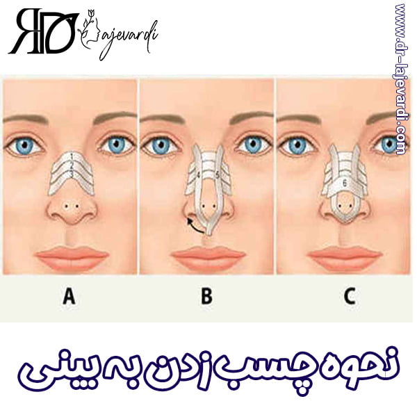 چسب زدن به بینی - دکتر محمد لاجوردی