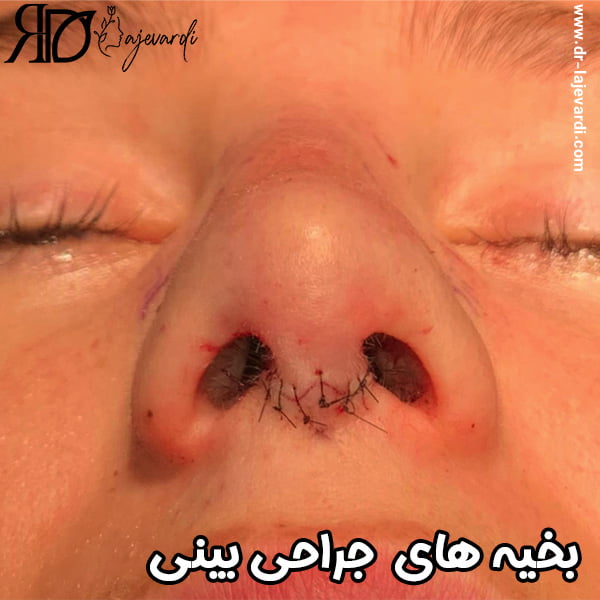بخیه های جراحی بینی - دکتر محمد لاجوردی