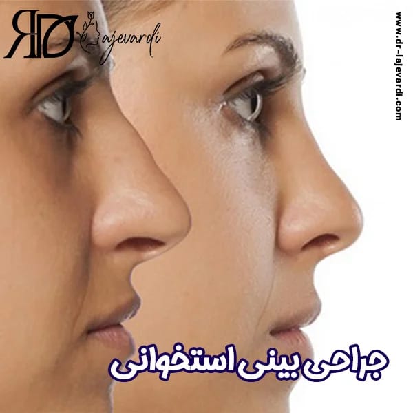جراحی بینی استخوانی - دکتر محمد لاجوردی