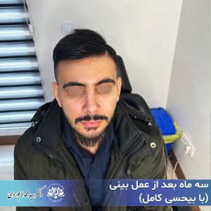 جراحی بینی با بیحسی - دکتر محمد لاجوردی