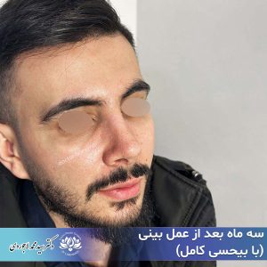 جراحی بینی با بیحسی - دکتر محمد لاجوردی