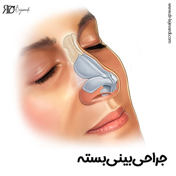 جراحی بینی بسته - دکتر محمد لاجوردی