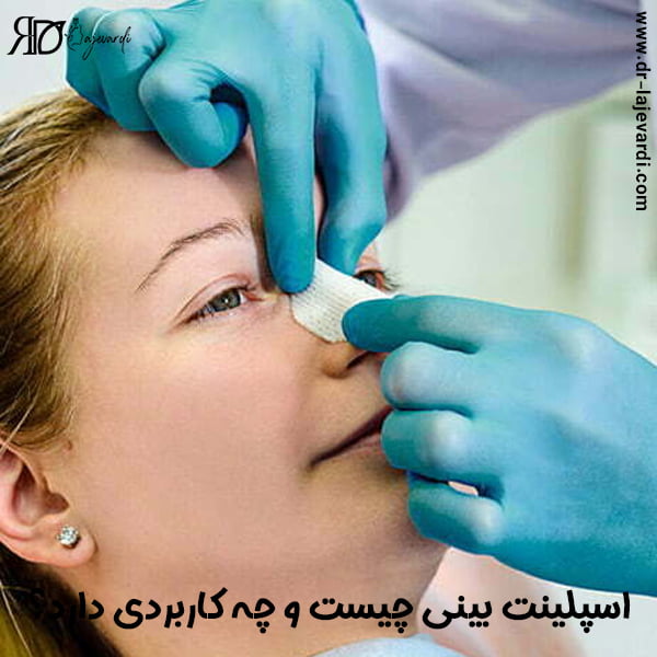 اسپلینت بینی - دکتر محمد لاجوردی