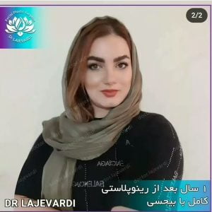 عمل بینی با بیحسی - دکتر محمد لاجوردی