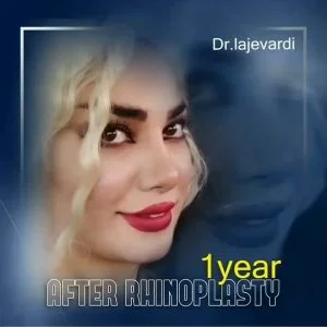 رینوپلاستی در تهران - دکتر محمد لاجوردی