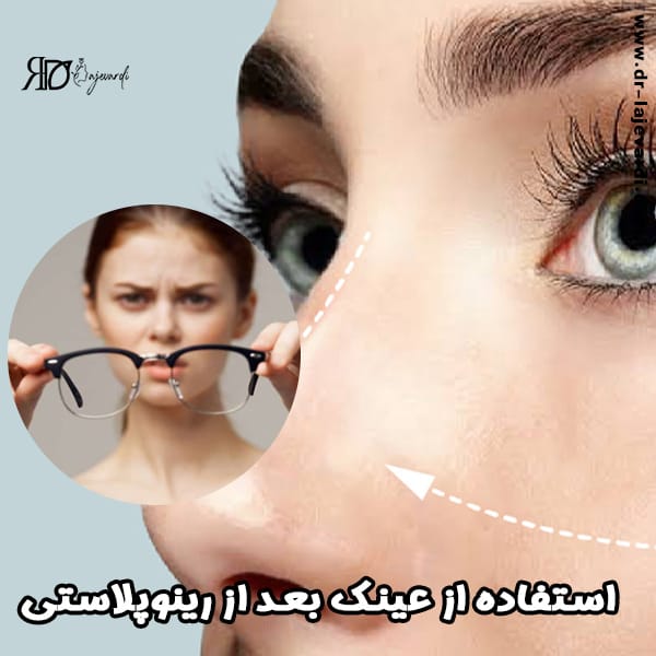 عینک زدن بعد از عمل بینی- دکتر محمد لاجوردی