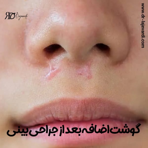 گوشت اضافه بعد از جراحی بینی - دکتر محمد لاجوردی